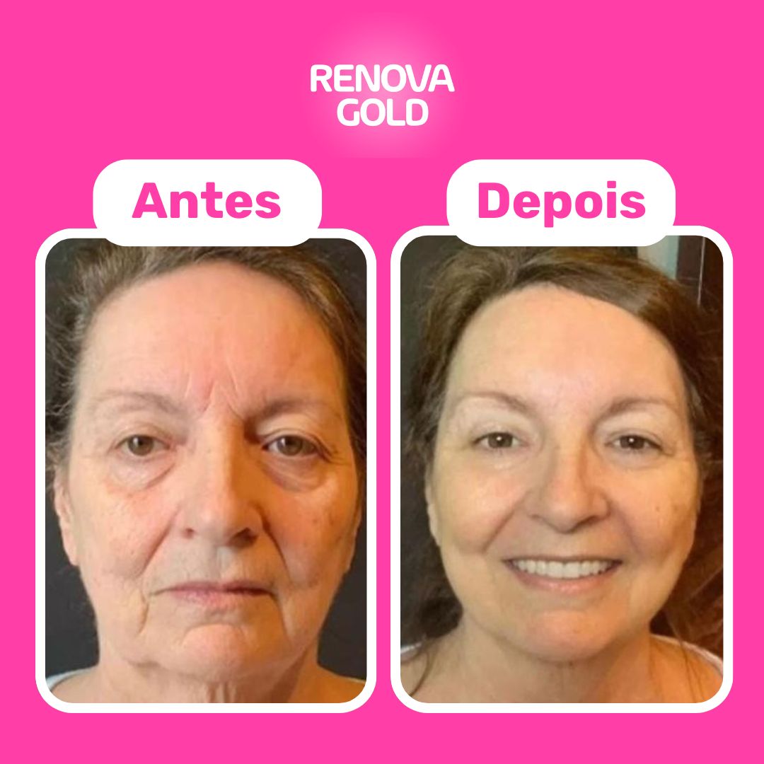 antes-depois-renova-gold.jpg