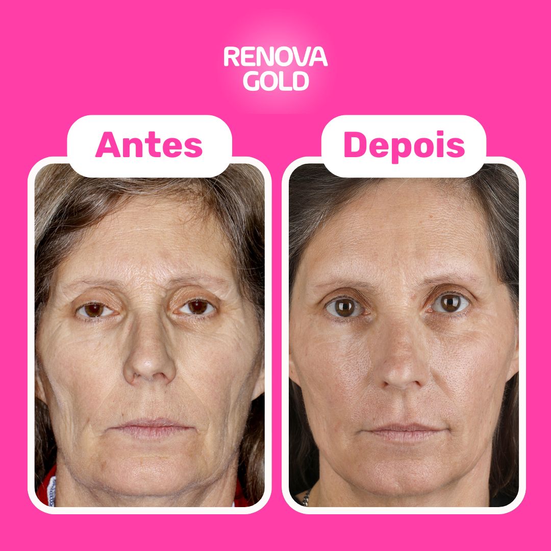 renova-gold-antes-depois.jpg