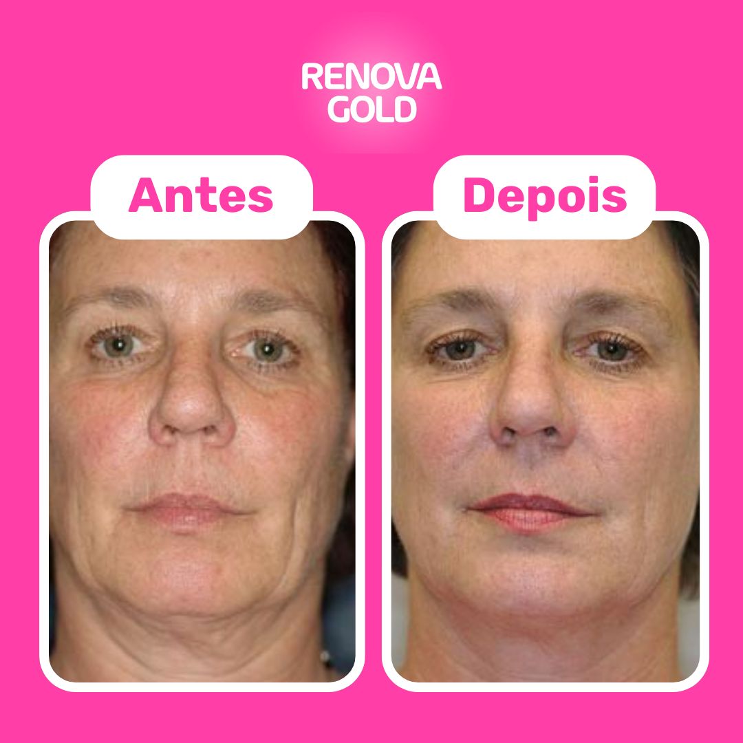 renova-gold-antes-e-depois-cliente.jpg